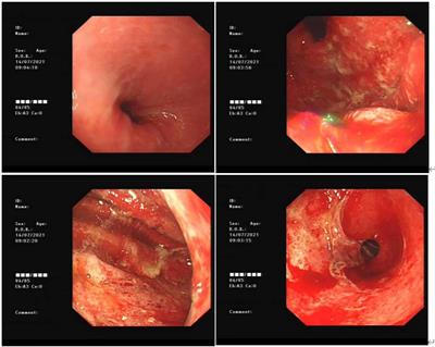 Upper Gastrointestinal Tract IrAEs: A Case Report About Sintilimab-Induced Acute Erosive Hemorrhagic Gastritis